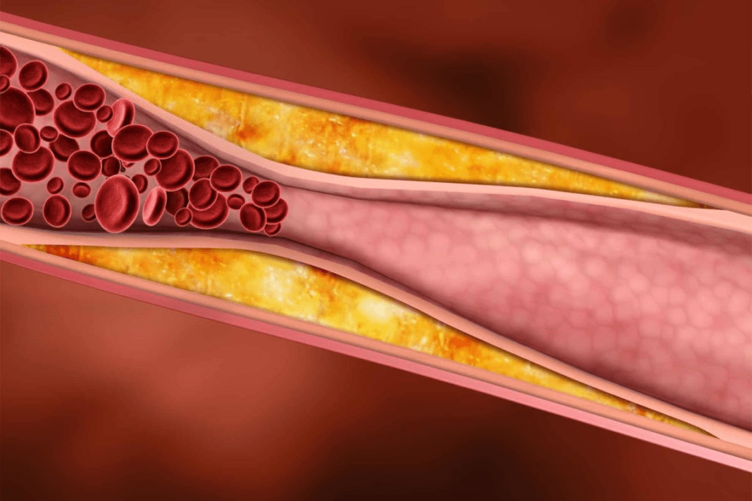 ATHEROSCLEROSIS