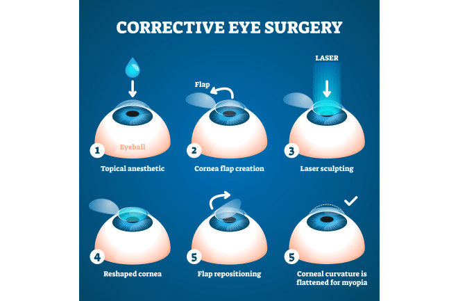 LASIK image https://meganews.tv/lasik-eye-surgery-a-safe-option/