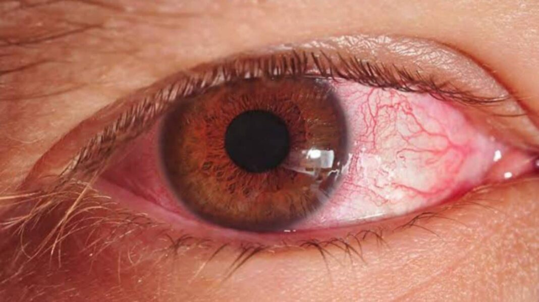 Conjunctivitis